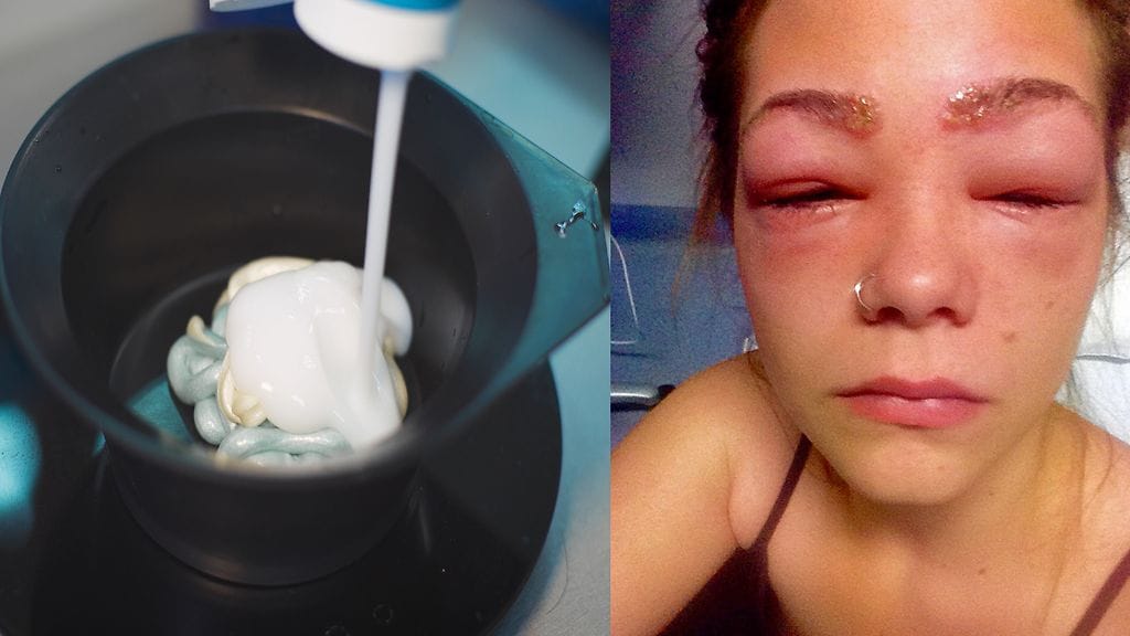 Värjäysaine sai aikaan naiselle harvinaisen, mutta vakavan reakton.