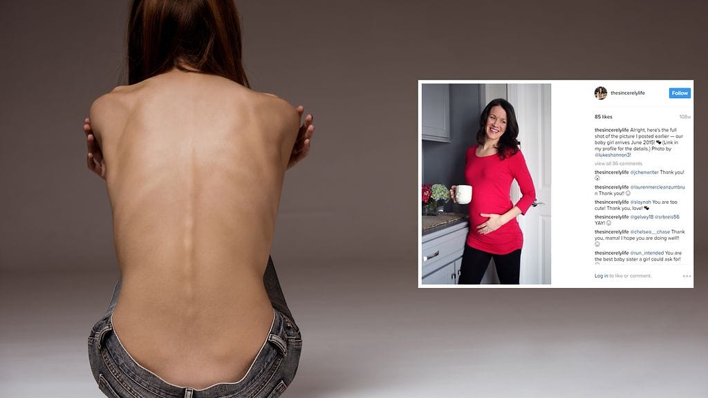 Raskaus muutti 15 vuotta syömishäiriöstä kärsineen naisen ajatusmaailman.