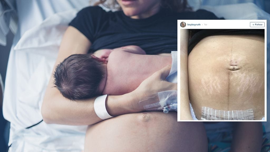 Äiti päätti jakaa kuvan synnytyksen jälkeisestä vatsastaan auttaakseen muita samassa tilanteessa olevia.