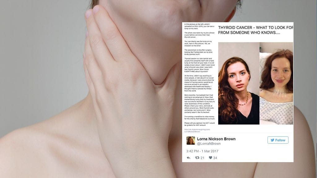 Kilpirauhassyöpään sairastunut nainen haluaa kertoa tämän harvinaisen syövän oireista.