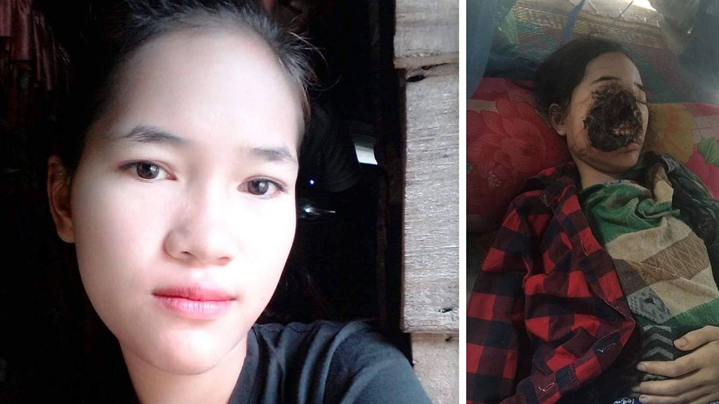 Suth Ret, 18, ennen leikkausta ja sen jälkeen.