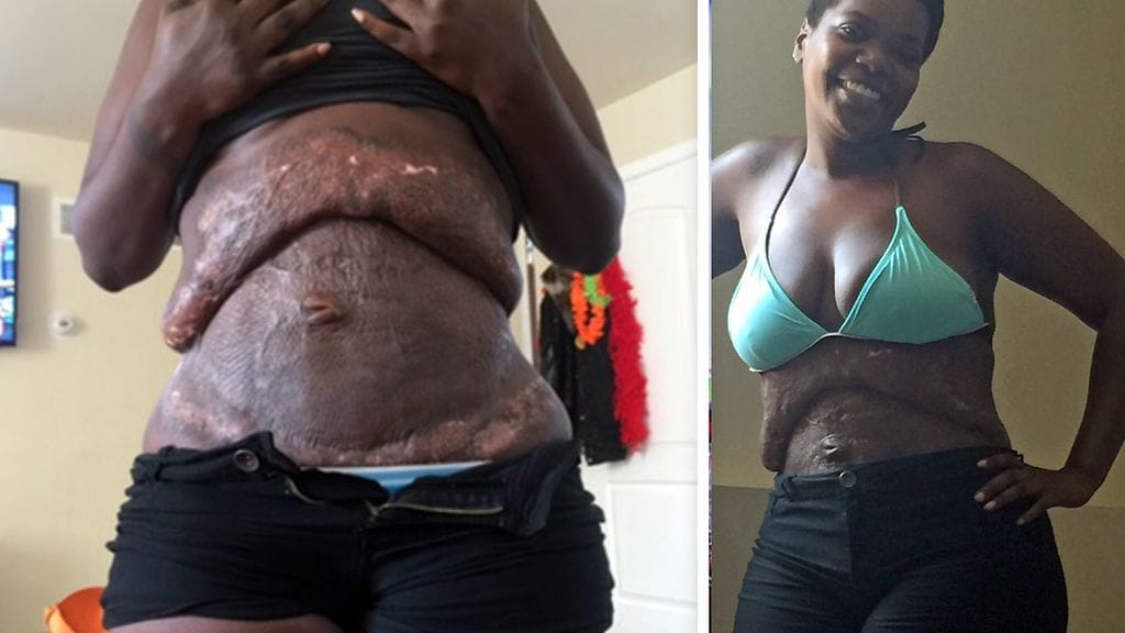 Tällainen oli leikkauksen tulos.