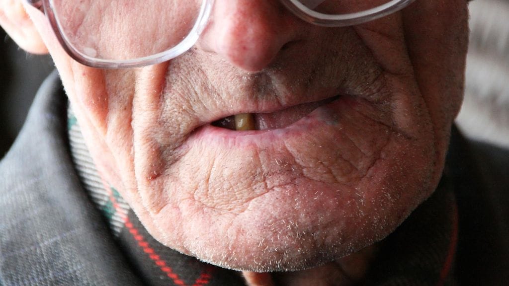 Dementiariski on kohonnut useampia hampaita menettäneillä. Kuvituskuva.