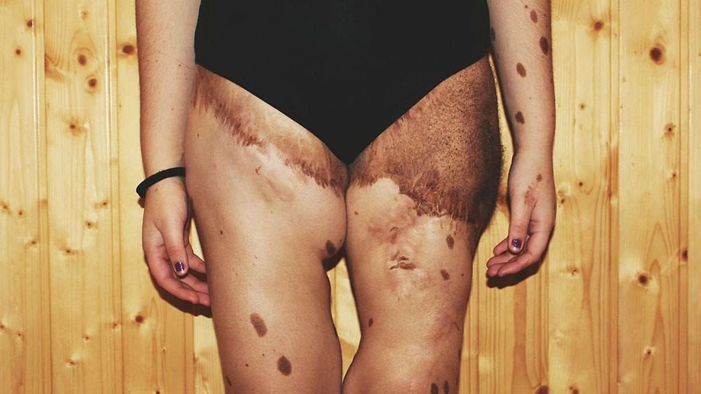 CATERS_TEEN_CALLED_DALMATIAN_FOR_500_BIRTHMARKS_08