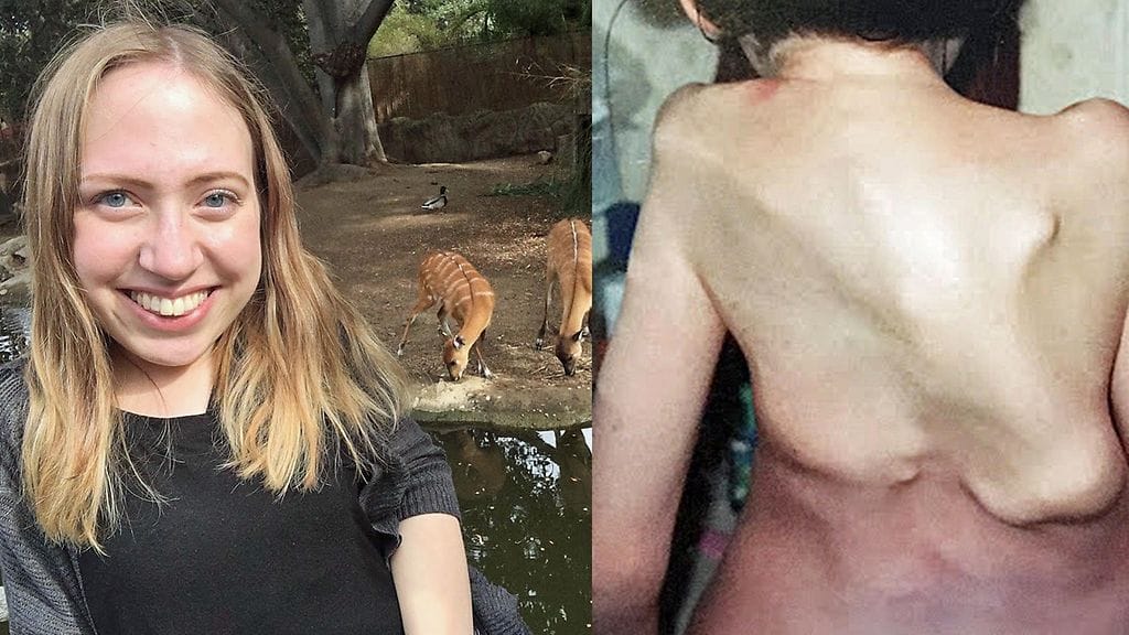 Kuvassa Jasmin aikuisena sekä Jasminin selkä vuonna 2004, kun hän oli 11-vuotias.