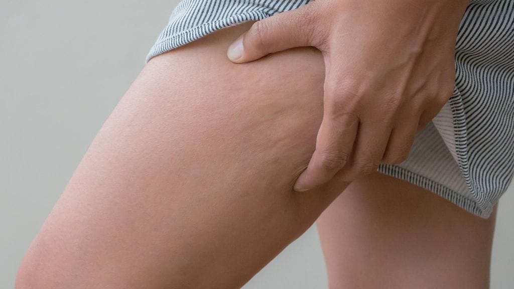 Asiantuntija lupaa, että yksinkertainen seos sulattaa muhkurat hetkessä.