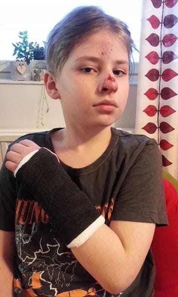 Matias Ylinen joutui auton yliajamaksi Naantalissa 21.3.2017