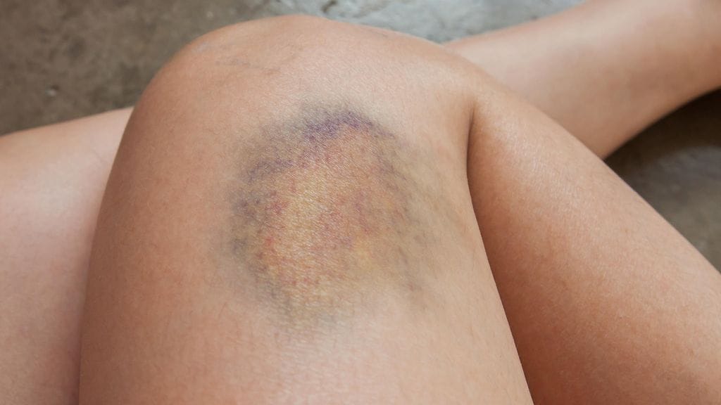 Osalle tulee mustelmia helpommin kuin toisille.