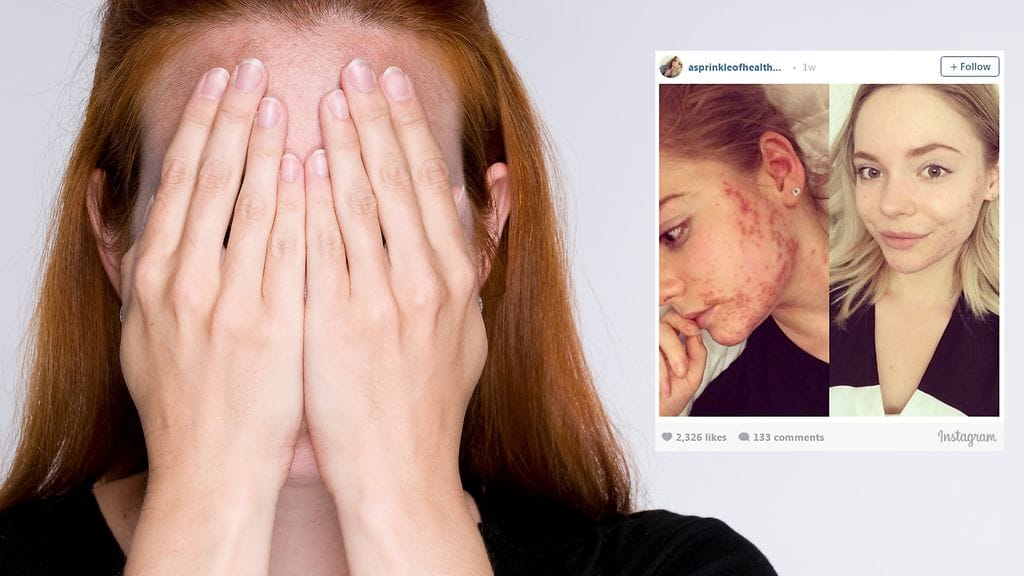 Nainen toivoo näyttävänsä esimerkkiä kaikille epävarmuudestä kärsiville tytöille.