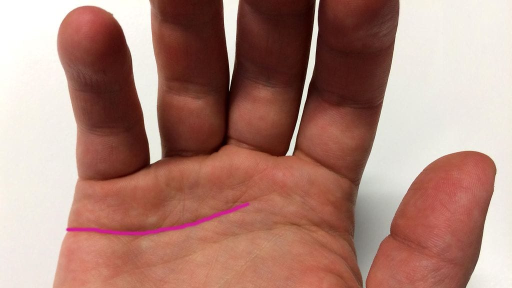 Joillain ihmisillä on vain yksi uurre kolmen sijaan.