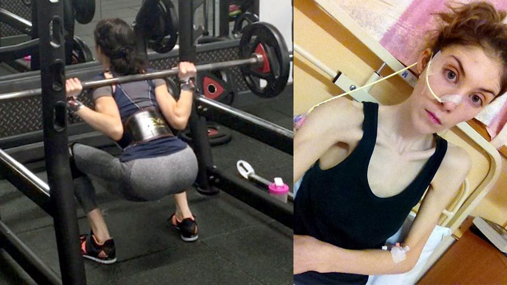 Neljä vuotta anoreksian kanssa kamppaillut nainen treenaa nykyisin ahkerasti kuntosalilla kasvattaakseen lihaksiaan.