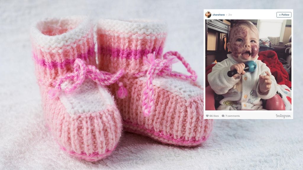 Willow-tytön tummia syntymämerkkejä pyritään vaalentamaan laserhoidoilla.