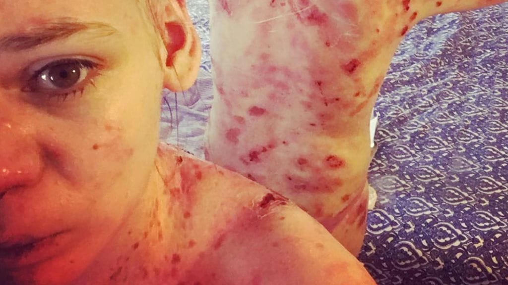 Perinnöllinen rakkulatauti aiheuttaa haavaumia tytön ihoon.