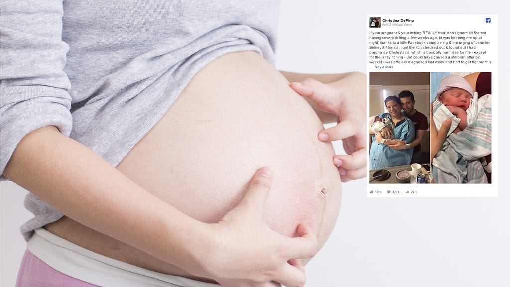 Raskauden aikaiseen hallitsemattomaan kutinaan tulisi aina puuttua ajoissa.