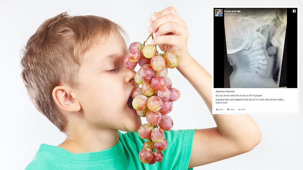 Kokonaisena nielty viinirypäle aiheutti lapselle hengenvaaran.