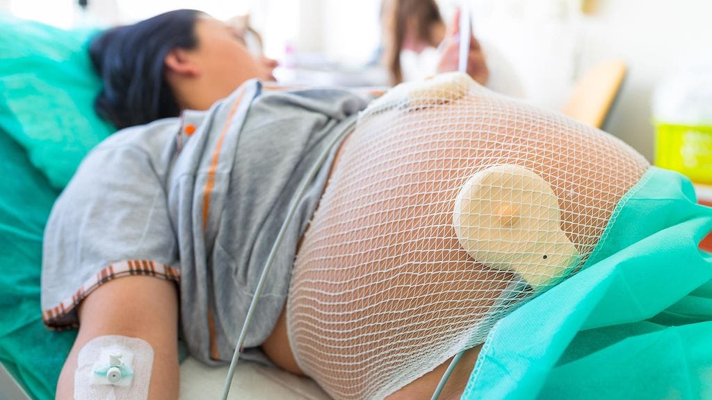 synnytys keisarinleikkaus