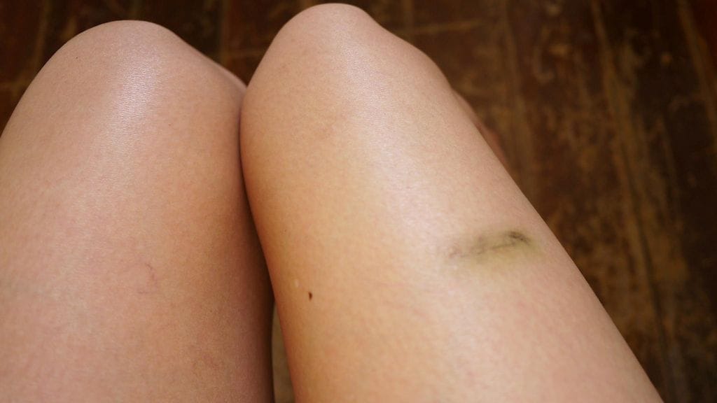 Kiputilat ja jalkoihin ilmestyneet mustelmat paljastuivat leukemian oireiksi. Kuvituskuva.