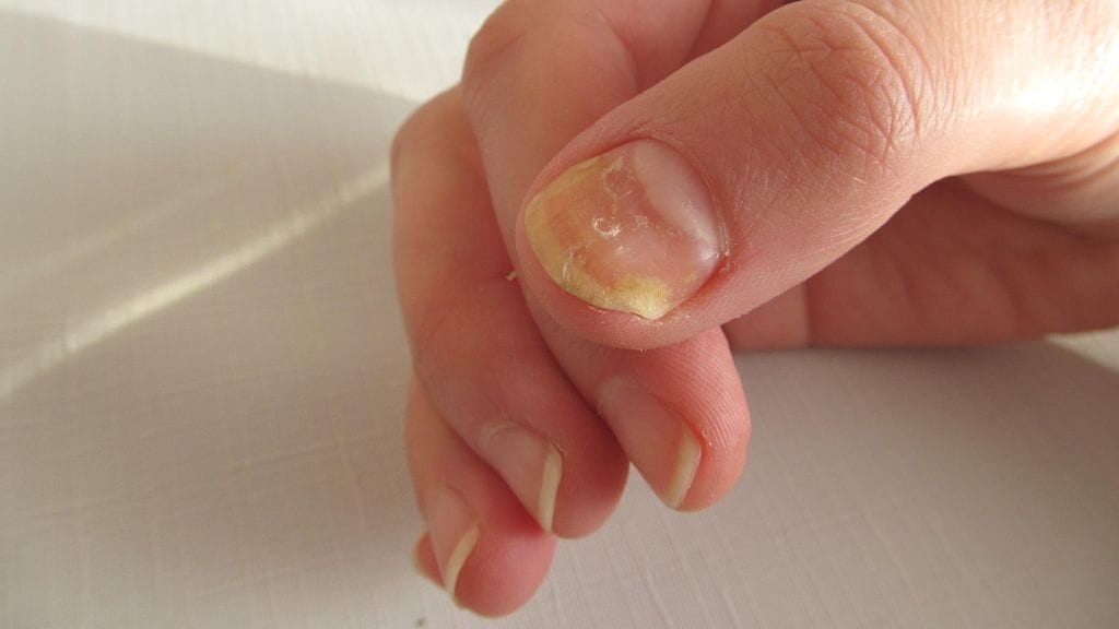 Kynsien keltaisuuteen voi olla monia syitä.