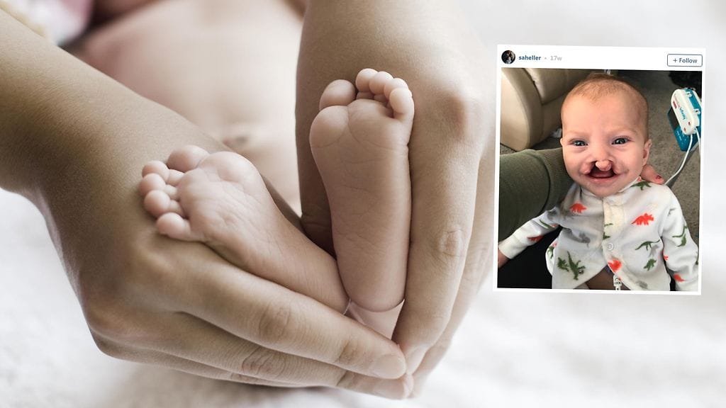 Muutaman kuukauden ikäinen vauva joutui haukkujen kohteeksi huulihalkionsa vuoksi.