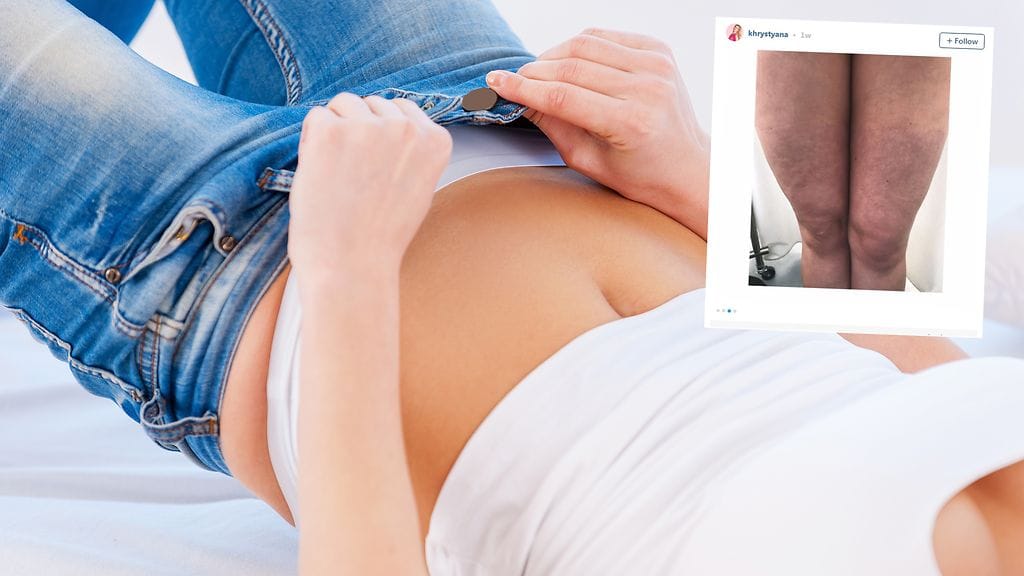 Tiukat farkut aiheuttivat naiselle ikäviä seuraamuksia.