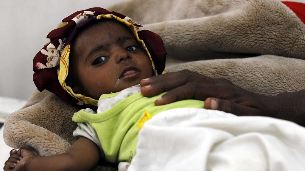 Aliravittu lapsi saa hoitoa sairaalassa Jemenissä.