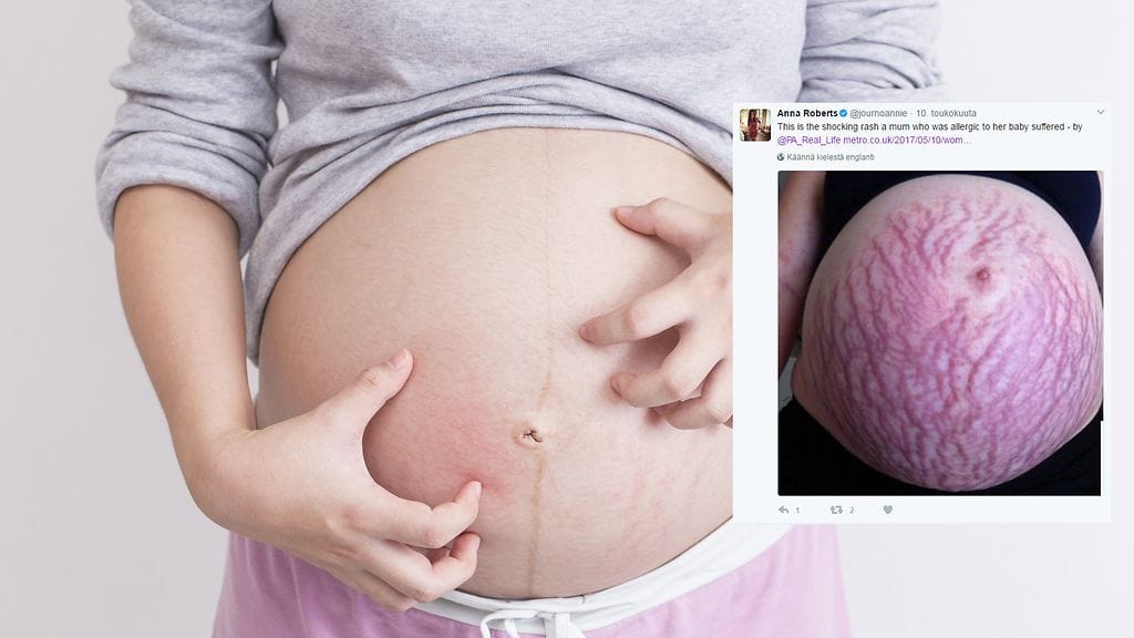 Monimuotoisesta raskausihottumasta kärsinyt nainen kertoo jopa lääkäreiden ihmetelleen iho-oireiden vakavuutta.