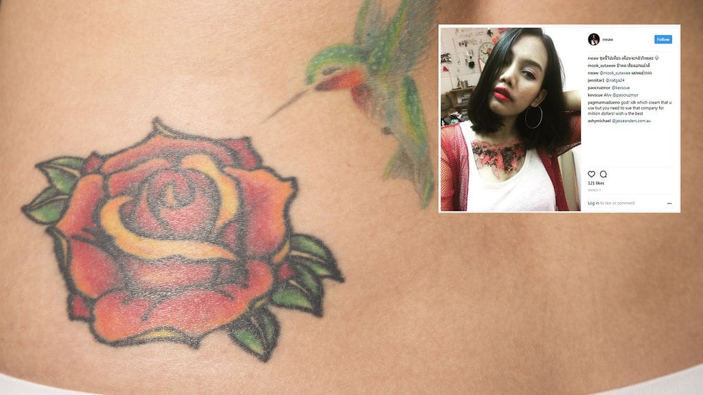 Kemikaalinen tatuoinnin poistomenetelmä aiheutti nuorelle opiskelijalle tuskaa, joka ei ole vieläkään ottanut laantuakseen.