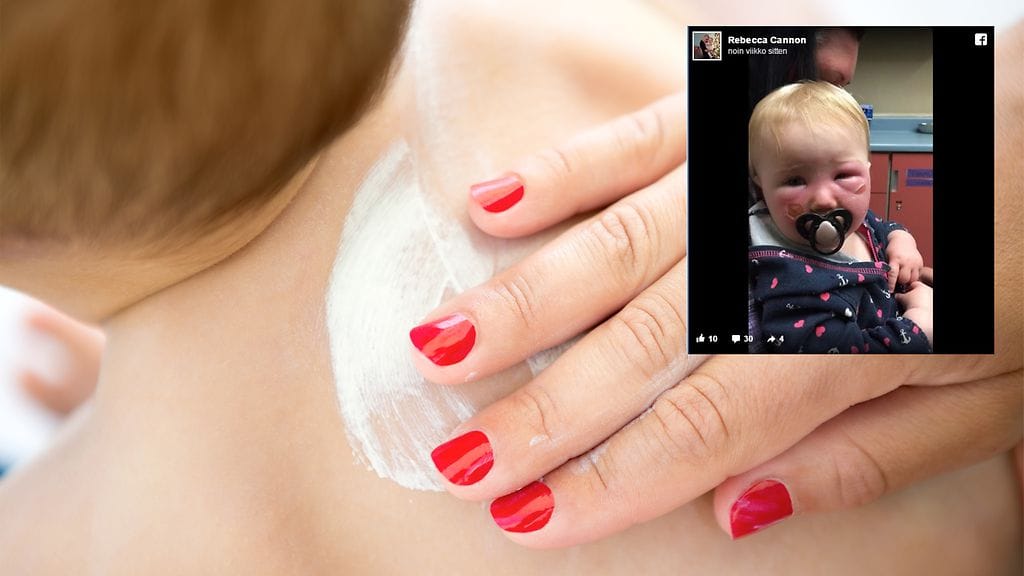 Vuoden ikäisen lapsen ihoon ilmestyi palovammoja, punoitusta ja turvotusta.