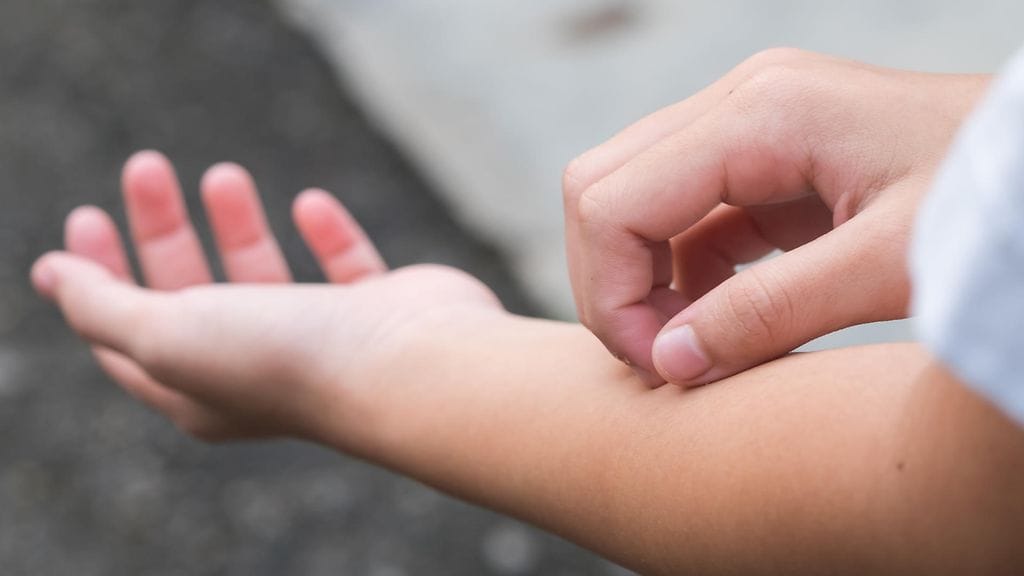 Nopeasti leviävä ihottuma on yksi meningokokkin aiheuttamista oireista.