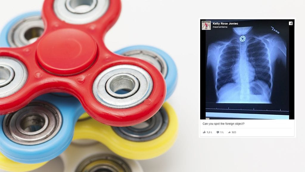 Suositusta fidget spinner -lelusta irronnut osa juuttui tytön ruokatorveen.