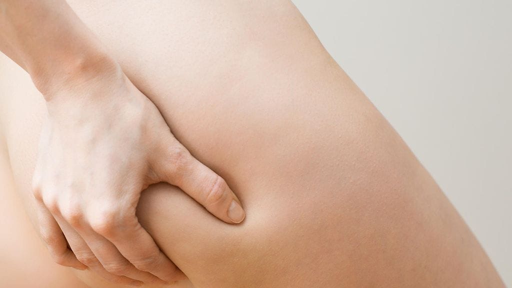 Selluliitti on naisen mukaan mitätön asia, jonka ei tulisi antaa vaikuttaa elämään millään tapaa.