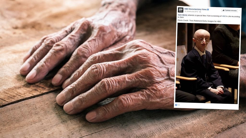 Äärimmäisen harvinainen syndrooma sai pojan kehon vanhenemaan tavallista nopeammin.