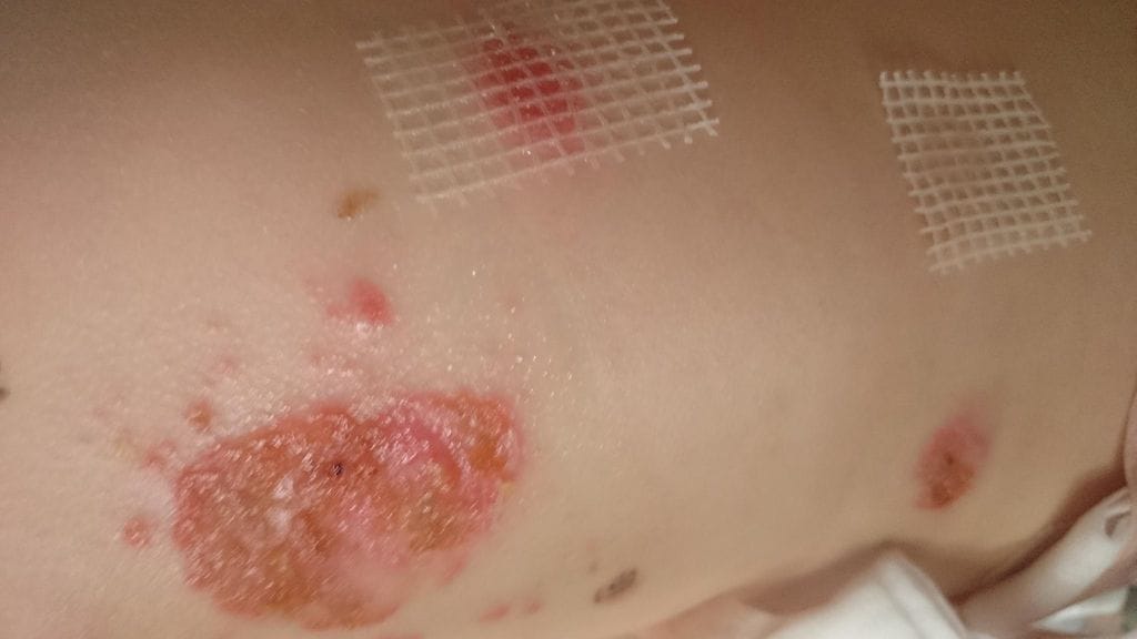 Näin järkyttäviä palovammoja 4-vuotias Kira sai jättiputken nesteen reagoitua auringonvalon kanssa. Nyt tyttö on kuitenkin paranemaan päin.