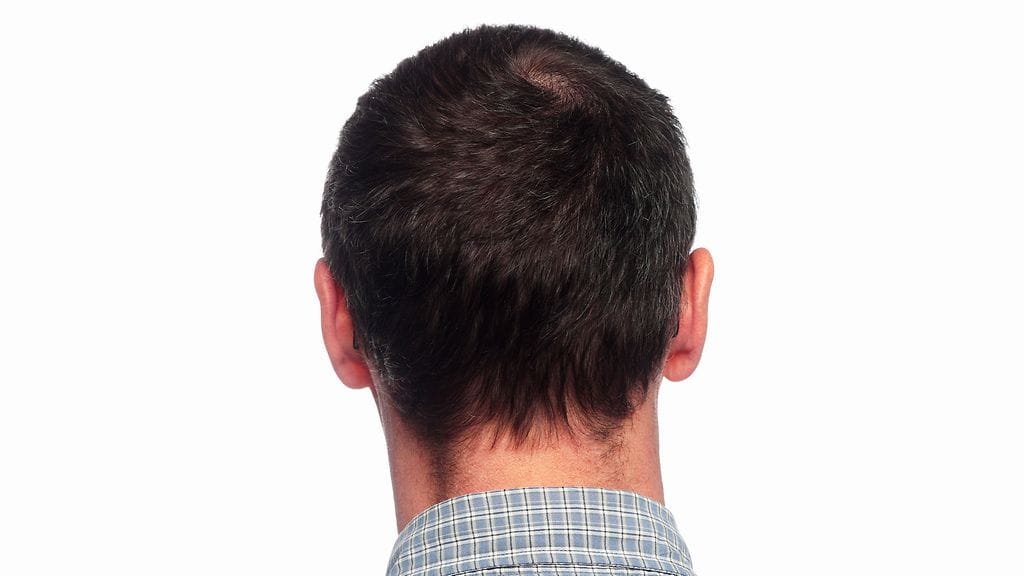 Dementiariski on sitä suurempi, mitä vakavampi aivovamma on ollut. Kuvituskuva.