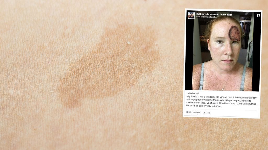 Nainen menetti lähes puolet otsansa ihosta ihosyövän vuoksi.