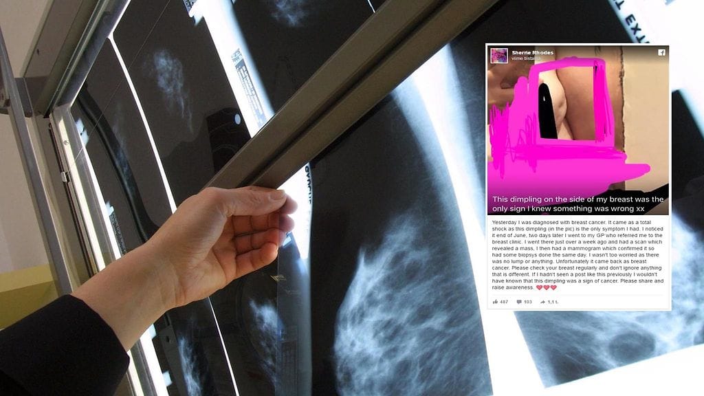 Naisen tarina on hyvä muistutus siitä, miksi rintojen säännöllinen tutkiminen kannattaa.