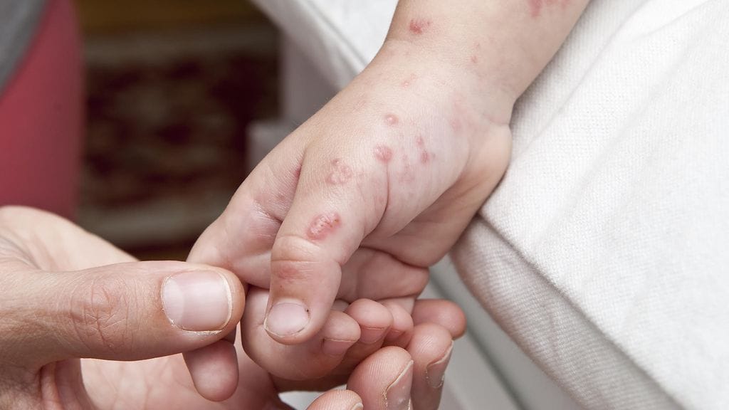 Rakot levisivät ympäri pojan kehoa. Kuvituskuva.