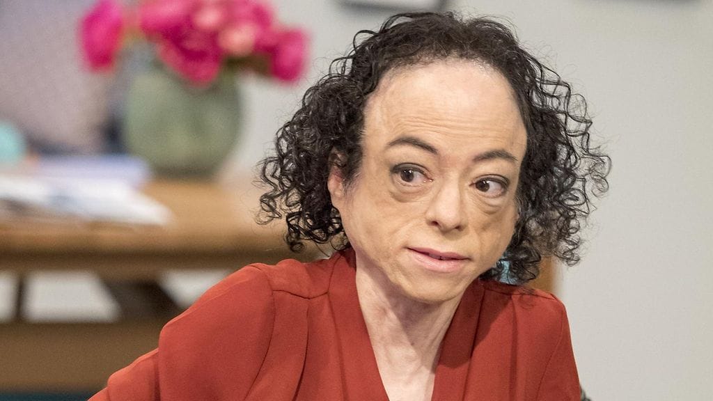 Brittinäyttelijä Liz Carrilla diagnosoitiin 7-vuotiaana hyvin harvinainen sairaus, jonka myötä hän viettää loppuelämänsä pyörätuolissa.