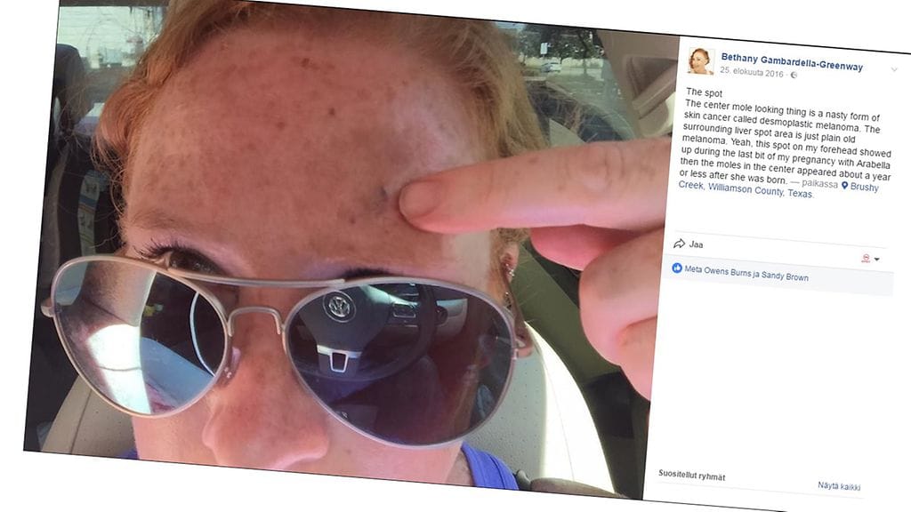 Bethany Greenawayn otsasta löytyi kahdenlaista melanoomaa.