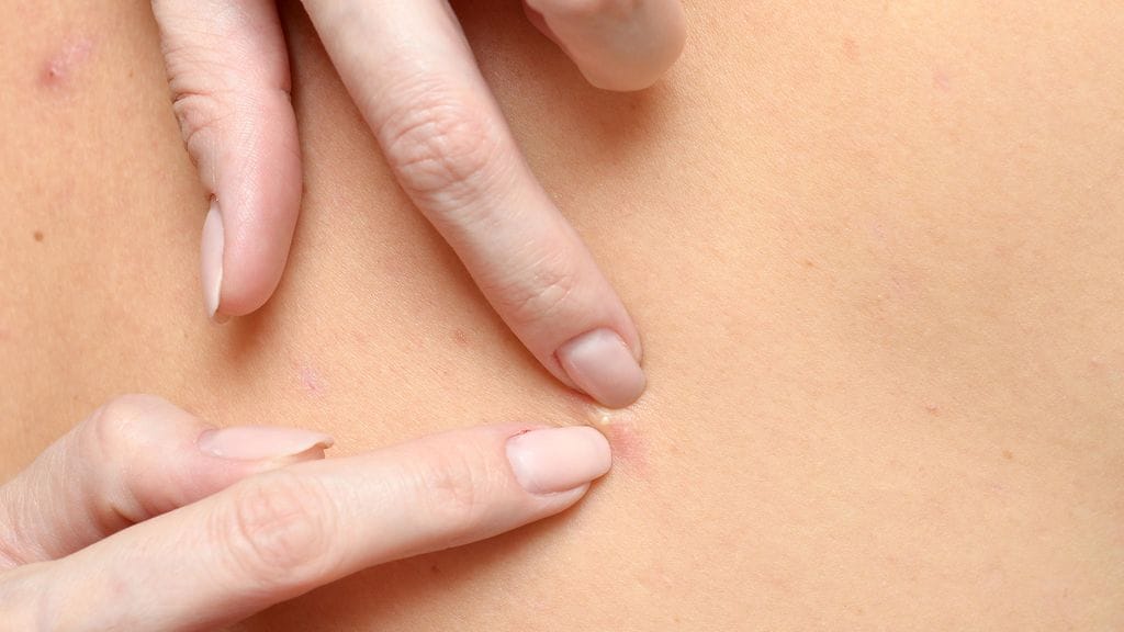 Samanlaista iloa saa paitsi omien finnien puristelusta, myös muiden näppylöiden hoitamisesta!