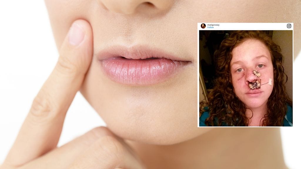 Nuori nainen oppi kantapään kautta, kuinka salakavala tauti ihosyöpä voi oikein olla.