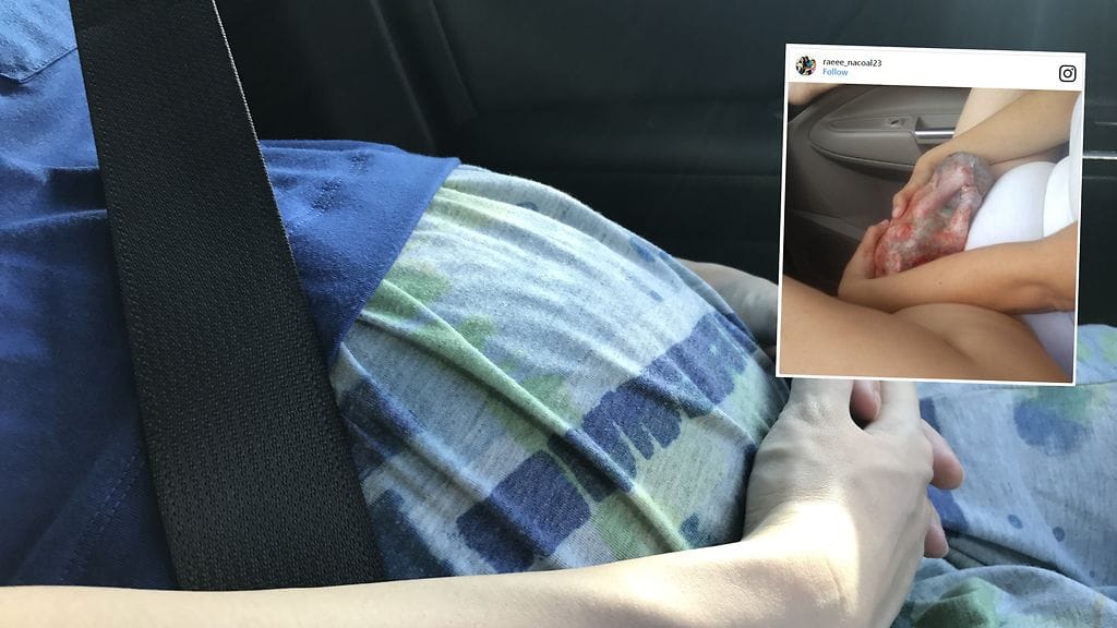 Sikiöpussissa syntyminen on yleisempää keisarinleikkauksessa kuin alatiesynnytyksessä.