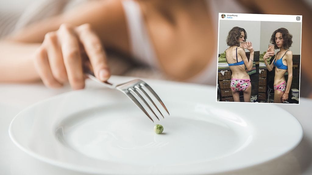 Teini-iässä alkanut painon tarkkailu johti syömishäiriön puhkeamiseen.