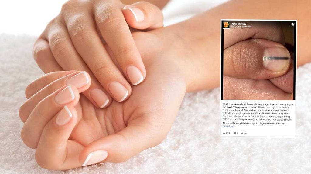 Tämä viattomalta näyttävä jälki paljastui aggressiiviseksi syöväksi.