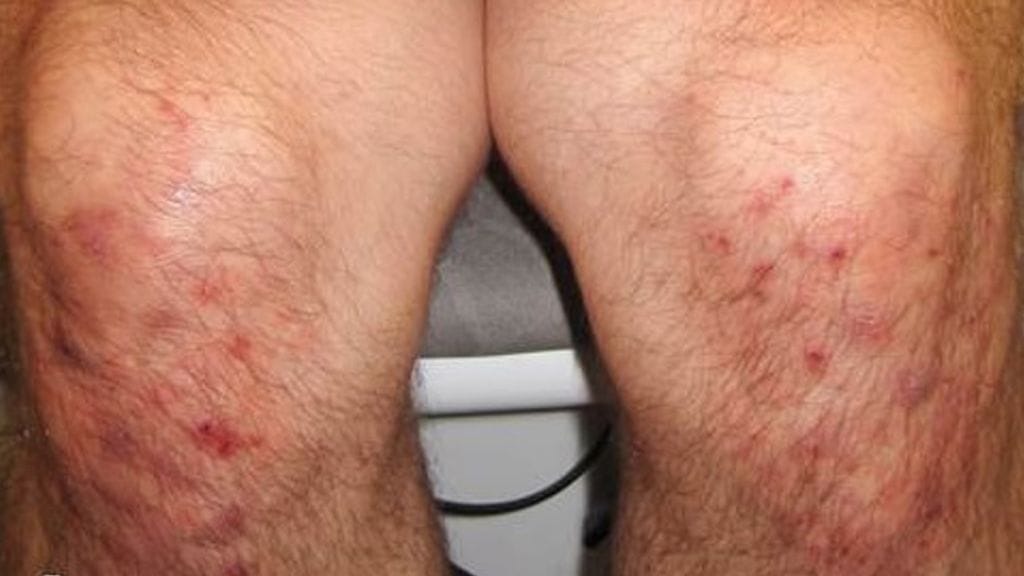 Ihokeliakiaihottumaa polvissa.