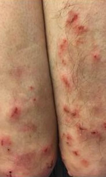 ihokeliakiakyynärpää