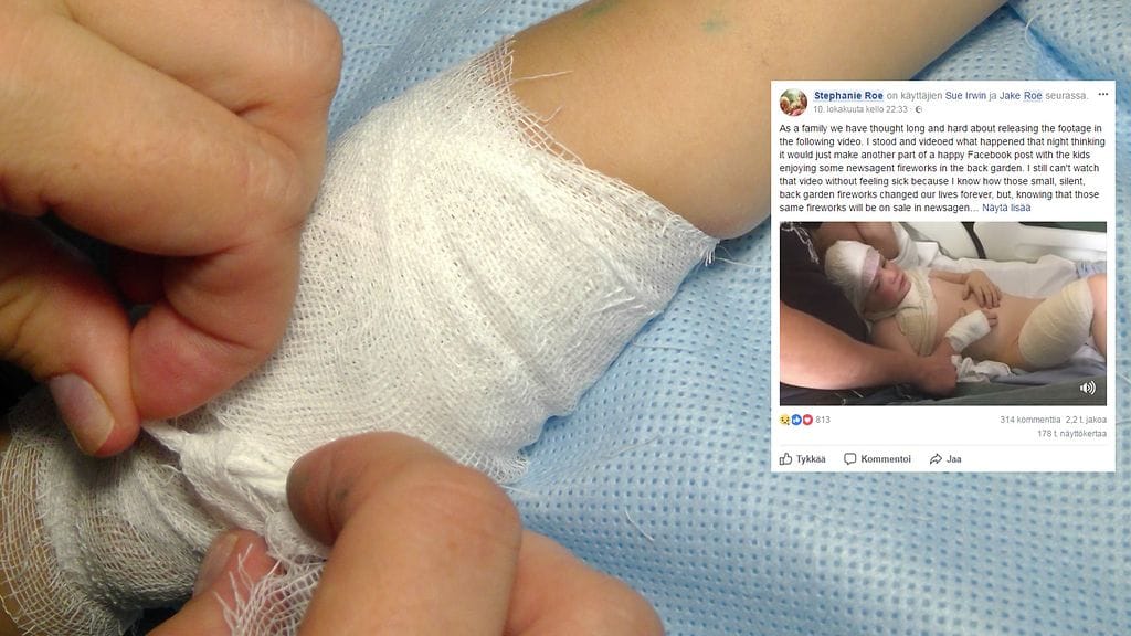 Viimeisen vuoden aikana vakavista palovammoista kärsivälle tytölle on suoritettu useita operaatioita.