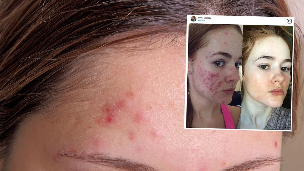 Nainen toivoo muuttavansa ihmisten käsitystä aknesta yksi selfie kerrallaan.