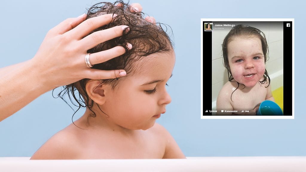 Kaksivuotiaan tytön iho-oireet ilmestyivät välittömästi hiustenpesun yhteydessä.