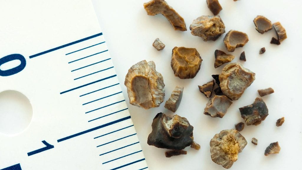 Alle viiden millin kokoiset virtsakivet poistuvat yleensä itsestään runsaan juomisen myötä.